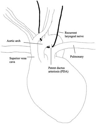 Iatrogenic pediatric unilateral vocal cord paralysis after cardiac surgery: a review